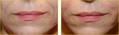 Artefill Wrinkle Reduction