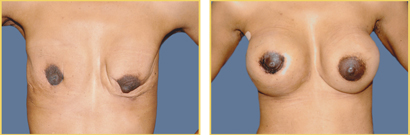 Before and After Breast Reconstruction