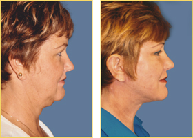 Before and After Facelift