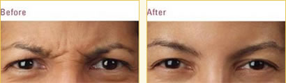 Botox