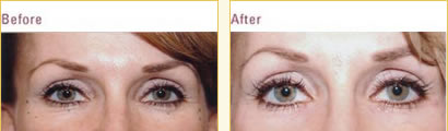 Botox