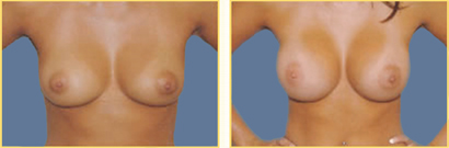 Breast Augmentation