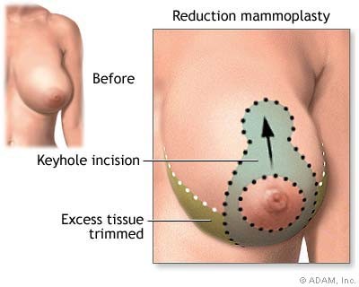 Keyhole, anchor, or wise pattern incision