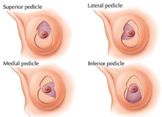 Breast reduction techniques