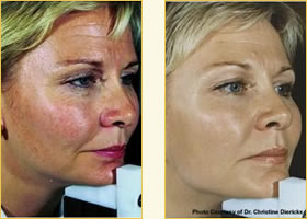 Chemical Peels