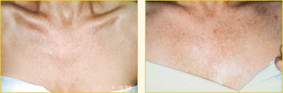 Chemical Peels