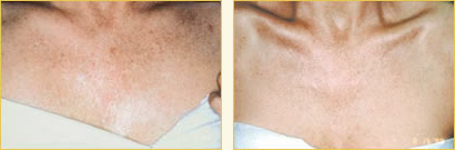 Chemical Peels