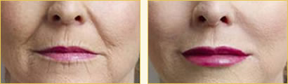 Collagen & Cosmoplast