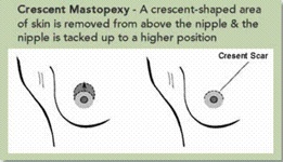 Superior Crescent Mastopexy