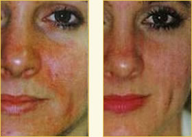 DiamondTome microdermabrasion