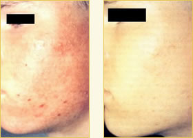 DiamondTome microdermabrasion