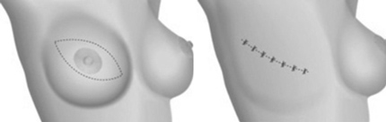 Ellipse Technique