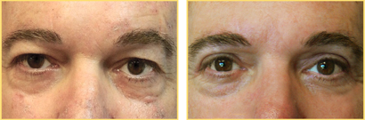 Eyelid Surgery