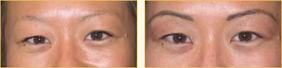 Cosmetic eyebrow tattoos