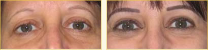 Cosmetic eyebrow tattoos