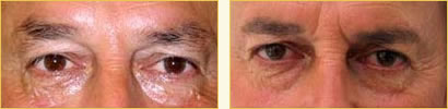 Cosmetic eyebrow tattoos