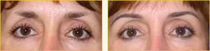 Cosmetic eyebrow tattoos