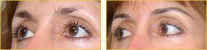 Cosmetic eyebrow tattoos