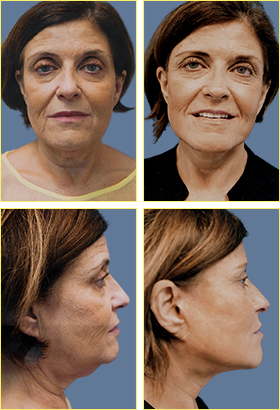 In Office Next Day Facelift