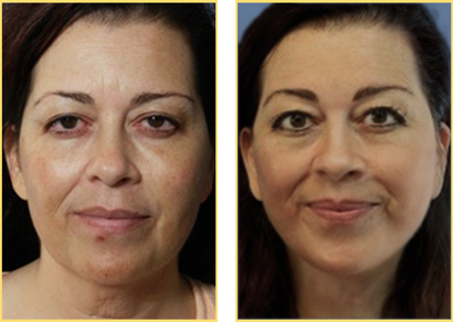 In Office Next Day Facelift