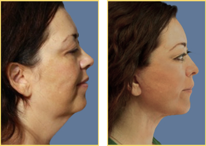 In Office Next Day Facelift