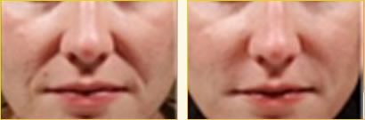 Juvederm Juvederm