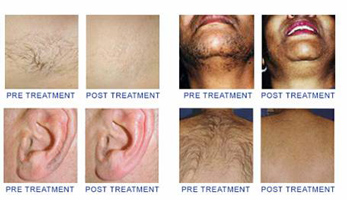 Laser Hair Removal Laser hair removal