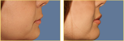 Lip Augmentation