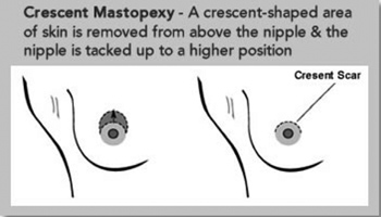 Crescent Mastopexy