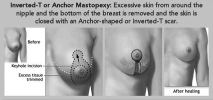 Inverted-T or Anchor Mastopexy