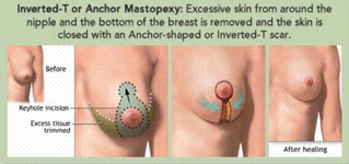 Anchor Mastopexy