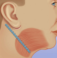 Microaire Ribbon