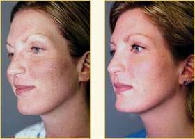 MicroLaser Peel