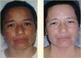 Melasma of pregnancy before and after 12 weeks of Nu-Derm