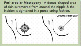 Donut Mastopexy