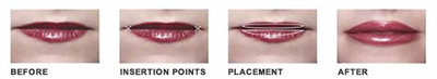 Permalip implant diagram