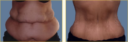 Post-Bariatric Surgery