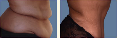 Post-Bariatric Surgery