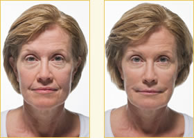 Radiesse Wrinkle Reduction