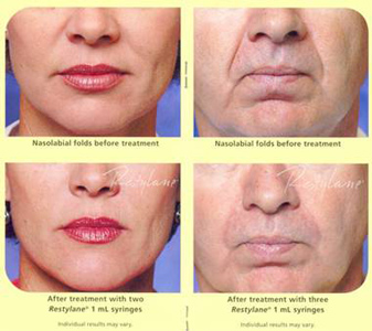 Restylane Restylane