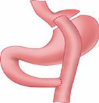Roux-en-Y Procedure