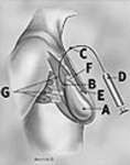 Saline expander