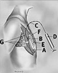 saline expanders