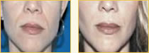 Sculptra