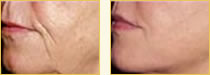 Sculptra