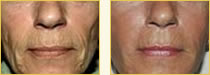 Sculptra