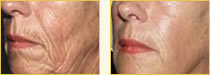 Sculptra Skin Filler