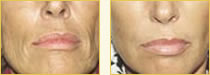 Sculptra