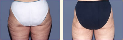 Thighplasty