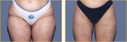 Thighplasty